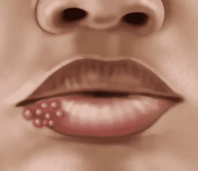 Syphillis_In_Women__ (1)