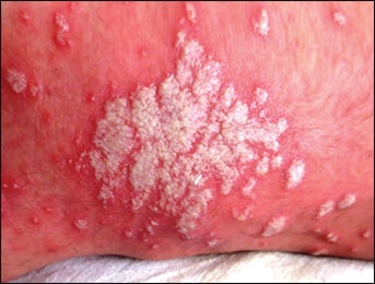 candidiasis