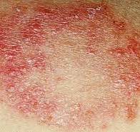 skin rashes infection image